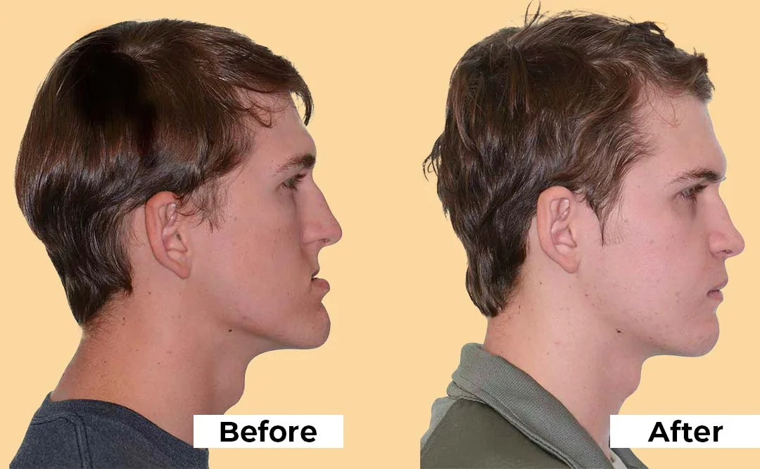 How Advanced Jaw Surgery Restores Function When Other Treatments Fail